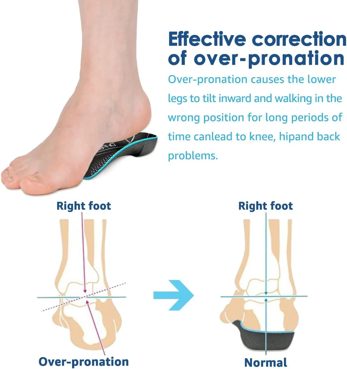 3/4 Plantar Fasciitis Insoles, High Arch Support Inserts for Flat Feet, Over-Pronation and Foot Pain, Metatarsal Support Insoles for Metatarsalgia (Medium(Men's 6.5-8.5, Women's 7.5-9.5))