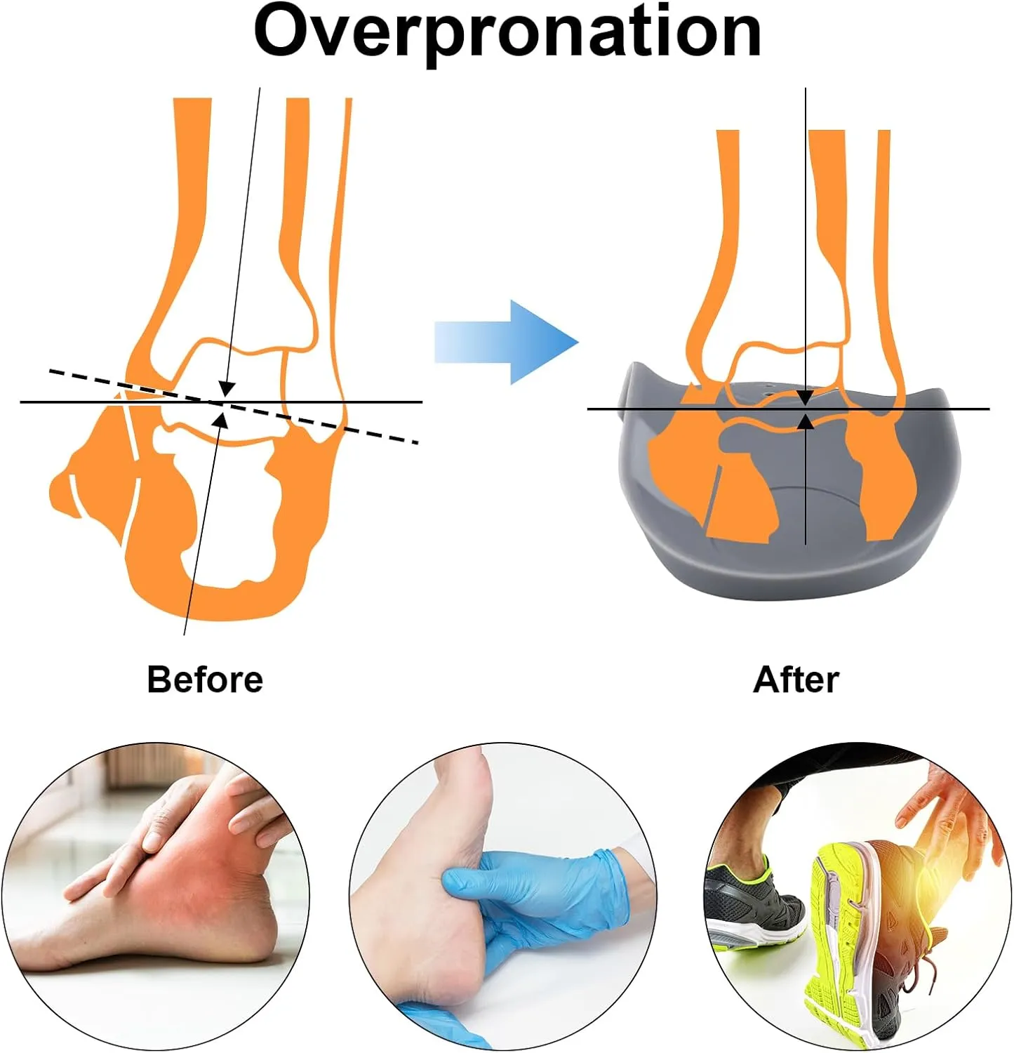 Original 3/4 Arch Support Metatarsal Support Orthotics Over-Pronation Insoles Relieve Plantar Fasciitis, Arch, Heel & Ankle Foot Pain (Gray, Men 9-12/Women 11-14)